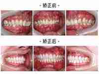 过往矫正(30岁在北京世纪城口腔矫正牙很成功)